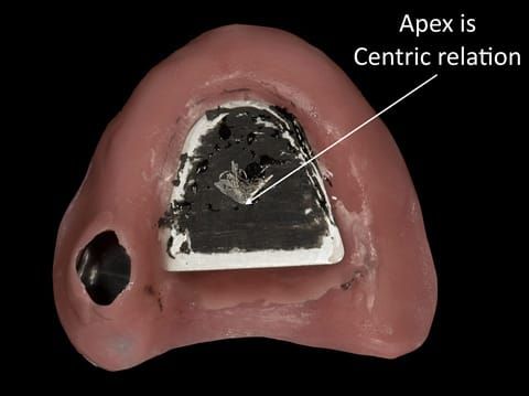 Figure 43. Visit 3 - Central bearing apparatus to record centric relation accurately - maxillary plate. The patient has scribed an arrow shape - the apex is centric relation. A plastic countersink hole is placed and fitted over the apex.