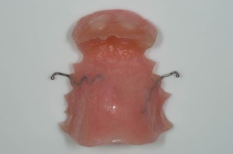 Figure 47. Chair-side reline appointment - 3 months after extractions. The denture teeth have been covered with a sheet of wax to prevent reline material (Ufi gel Hard - Voco) from flowing between the teeth. This speeds up trimming and polishing.