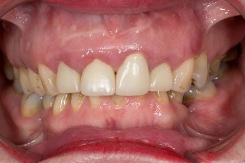 Figure 5. Pre-treatment - upper four incisors with inflammation of the gingivae and mis-match of the gingival levels.