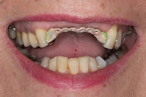 Figure 95. Maxillary cobalt chromium framework trial insertion, checking the fit onto the natural teeth using Occlude spray.