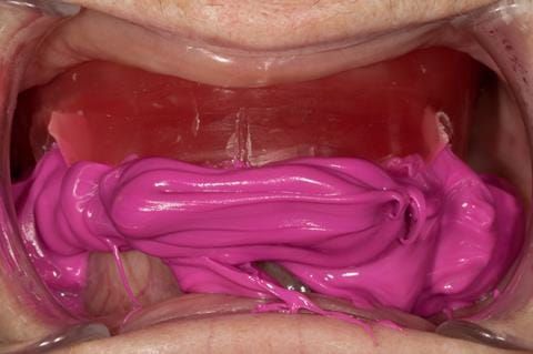 Figure 33. Visit 2 - Primary rim carved approximately to the desired OVD, allowing the definitive casts to be mounted on the articulator, for construction of the central bearing apparatus (gothic arch tracing) - Futar D bite registration material.