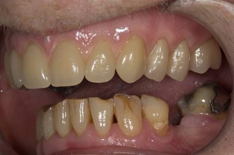 Figure 79. Visit 5 Fitted definitive denture - Schottlander Enigmalife teeth