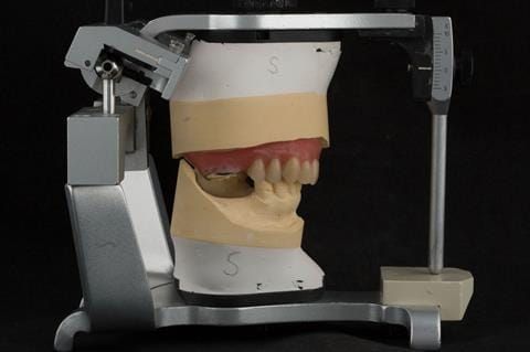 Figure 54. Teeth wax try in with Schottlander Enigmalife teeth in centric relation position determined by central bearing apparatus.