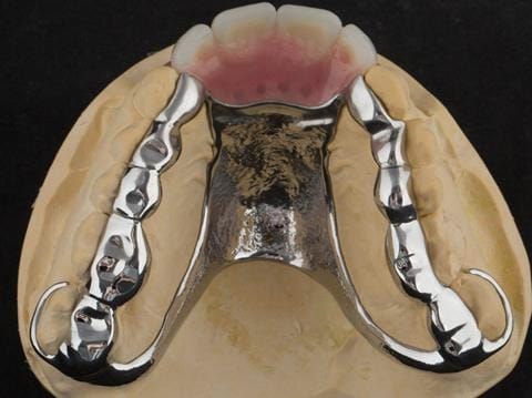 Figure 102. Finished cobalt chromium based maxillary partial denture. (Chris Hesketh, Bespoke Frameworks, Chorley, UK.)