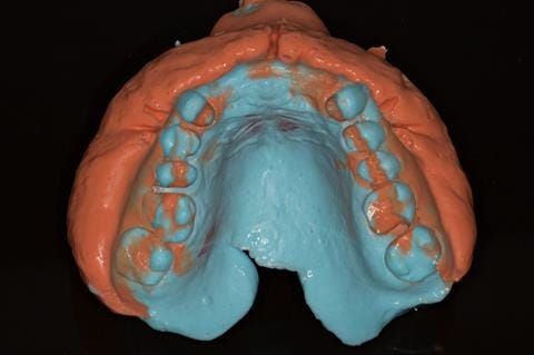 Figure 75. Primary impression - 2 part alginate - Accudent XD Ivoclar.