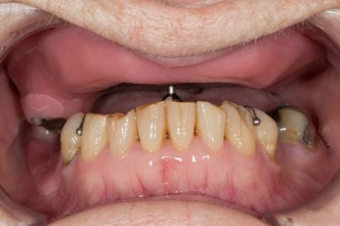 Figure 42. Visit 3 - Central bearing apparatus to record centric relation accurately. The mandibular pin is the only point of contact between the maxilla and mandible. The patient performs excursive movements - forwards, backwards and all over.
