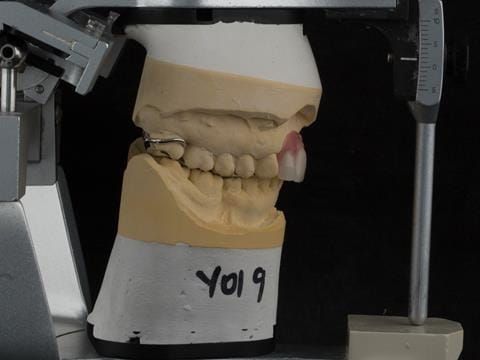 Figure 105. Definitive cast on Denar Mk 2 articulator - maxillary cast mounted using facebow transfer and mandibular cast mounted in intercuspal position with finished denture fitted.