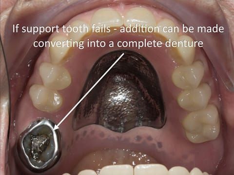 Figure 87. I warn the patient prior to commencing treatment that the denture will accelerate the demise of the remaining support tooth. In the event of failure an artificial tooth addition to the denture is simple.