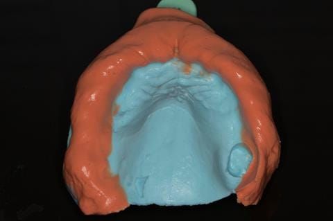 Figure 16. Visit 1. Maxillary primary impression made in two stages using Accudent XD, Ivoclar. This allows full extension to record the sulcus - particularly around the UL7
