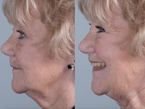 Figure 84. Fitted definitive denture