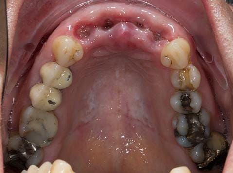 Figure 38. Healing sockets at 1 week review.