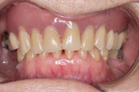 Figure 6. Pre-treatment with poorly fitting acrylic based maxillary partial denture - this denture was not worn by the patient