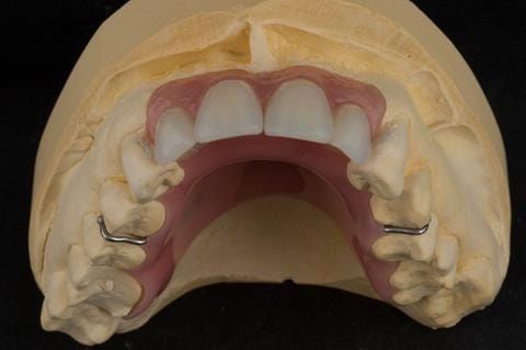 Figure 59. Relined immediate denture on cast.