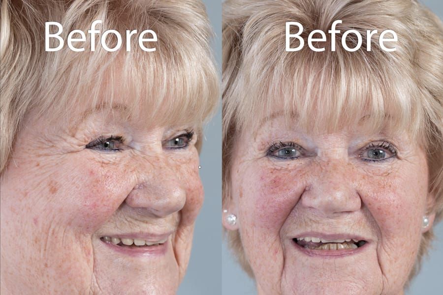 Figure 1 a & b. Pre-treatment with poorly fitting cobalt chromium based maxillary partial denture