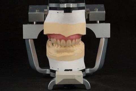 Figure 55. Teeth wax try in with Schottlander Enigmalife teeth in centric relation position determined by central bearing apparatus.
