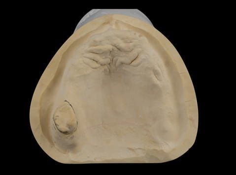 Figure 51. Definitive maxillary cast.