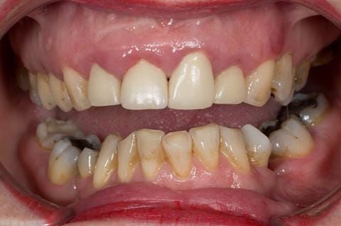 Figure 6. Pre-treatment - upper four incisors with inflammation of the gingivae and mis-match of the gingival levels.
