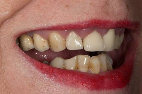 Figure 3. Pre-treatment showing high smile line and aesthetically poor upper incisors 