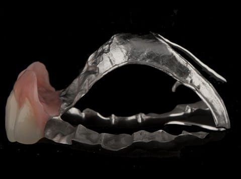 Figure 106. Finished cobalt chromium based maxillary partial denture with Schottlander Enigmalife teeth. Note the thin knife edge flange to blend into the natural gingivae.