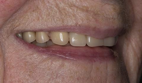 Figure 3. Pre-treatment with poorly fitting cobalt chromium based maxillary partial denture 