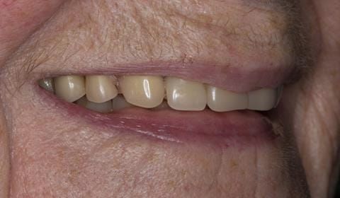 Figure 3. Pre-treatment with poorly fitting cobalt chromium based maxillary partial denture