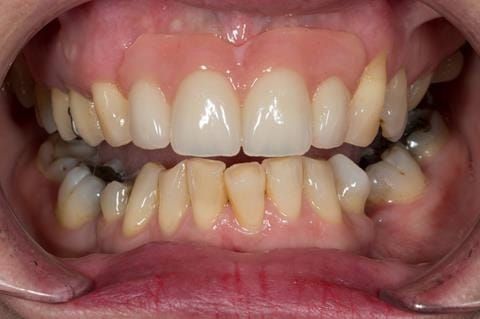 Figure 71. Immediate denture at 11 months post extraction. Ready to start making definitive cobalt chromium based partial denture.