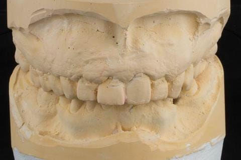 Figure 20. Duplicate of the primary cast of the maxillary arch showing good extension - enabling the construction of acrylic based immediate partial denture.