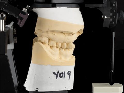 Figure 92. Definitive cast on Denar Mk 2 articulator - maxillary cast mounted using facebow transfer and mandibular cast mounted in intercuspal position.
