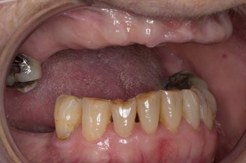 Figure 10. Pre-treatment - irregular mandibular occlusal plane. UR7 - occlusal and buccal amalgam.
