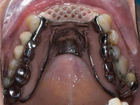 Figure 100. Maxillary cobalt chromium framework trial insertion, checking the fit onto the natural teeth using Occlude spray.