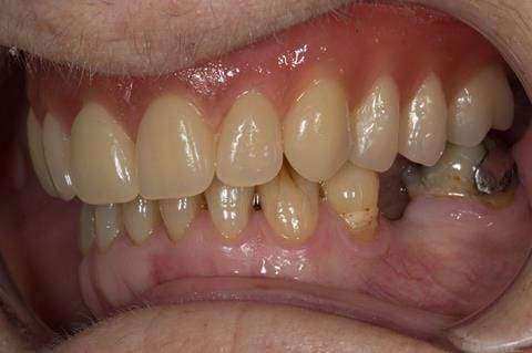 Figure 58. Visit 4 Teeth wax try in with Schottlander Enigmalife teeth in mouth in centric relation position.