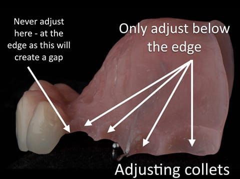 Figure 26. Maxillary immediate partial denture finished. When fitting I always adjust below area where the denture touches the tooth as in the photograph. This prevents a gap forming between the denture and the teeth when fitted - as shown in Figure 32.