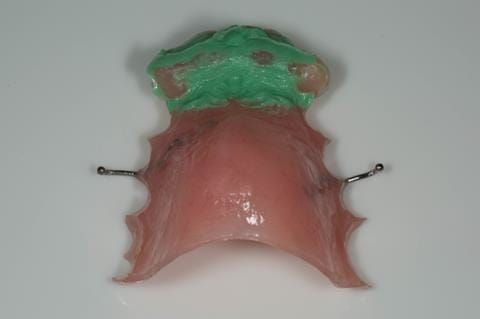 Figure 45. Chair-side reline appointment - 3 months after extractions. Space check with light bodied silicone impression material (Doric Flo light - Schottlander) - indicating how much chair-side reline to use.