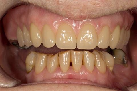 Figure 75. Visit 5 Fitted definitive denture - Schottlander Enigmalife teeth