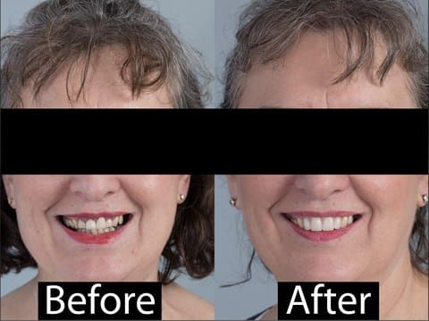 Figure 122. Before and after provision of a cobalt chromium based maxillary partial denture replacing upper 2-2.