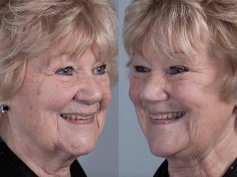 Figure 85. Fitted definitive denture