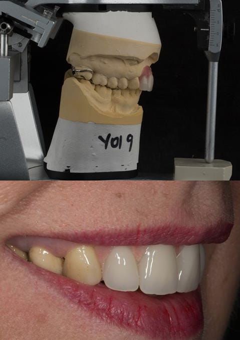 Figure 119. Fitted cobalt chromium based maxillary partial denture replacing upper 2-2 with teeth apart. Schottlander Enigmalife teeth.