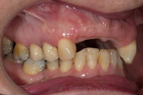 Figure 112. Edentulous ridge 12 months post extraction.