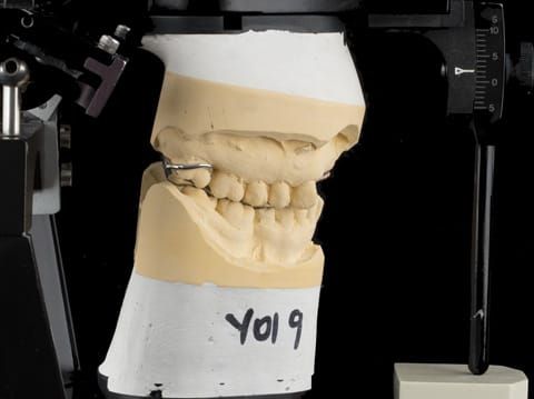 Figure 93. Definitive cast on Denar Mk 2 articulator - maxillary cast mounted using facebow transfer and mandibular cast mounted in intercuspal position with cobalt chromium framework fitted.