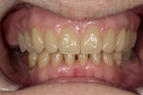 Figure 74. Visit 5 Fitted definitive denture - Schottlander Enigmalife teeth