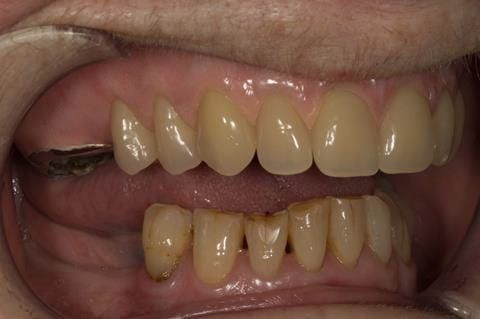 Figure 77. Visit 5 Fitted definitive denture - Schottlander Enigmalife teeth