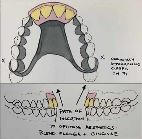 Figure 15. Design of definitive maxillary cobalt chromium based partial denture. Support derived from the remaining natural teeth. The heavily restored posterior dentition to be protected by partial occlusal coverage in metal.