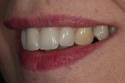 Figure 118. Fitted cobalt chromium based maxillary partial denture replacing upper 2-2 with teeth apart. Schottlander Enigmalife teeth.
