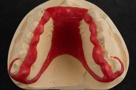 Figure 84. Pattern resin framework prototype of the cobalt chromium connectors to verify fit and occlusal relation.
