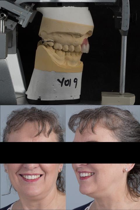Figure 121. Fitted cobalt chromium based maxillary partial denture replacing upper 2-2. Schottlander Enigmalife teeth.