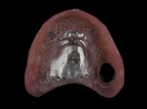 Figure 53. Wax try in intaglio surface.