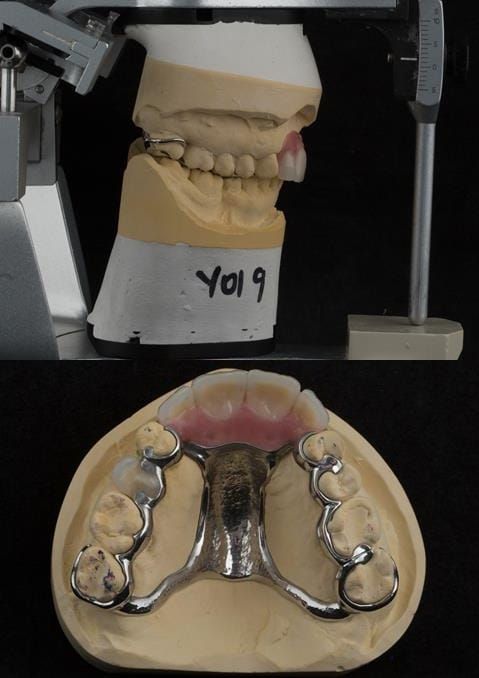 Figure 126. Cobalt chromium based maxillary partial denture from a different case of similar design. The upper right first premolar required removal at a later date. Dental bar designed using a laser welded tag to support the artificial tooth.