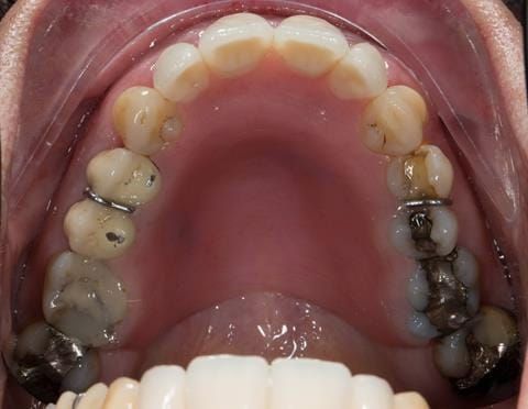 Figure 39. Maxillary immediate denture fitted one week after the extraction appointment.