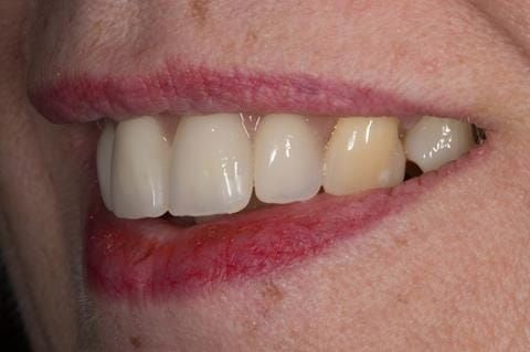 Figure 68. Relined immediate denture replacing maxillary incisors fitted 5 months after extraction.