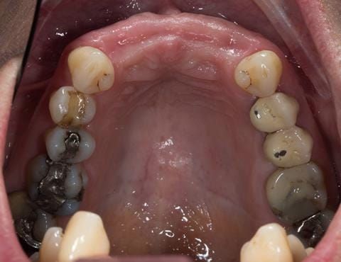Figure 43. Three months after extractions - ridge remodelling/shrinkage.